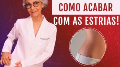 Estrias: o que são, prevenção e como combater!