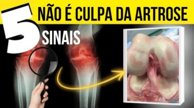 5 SINAIS QUE PODEM SIGNIFICAR ARTROSE