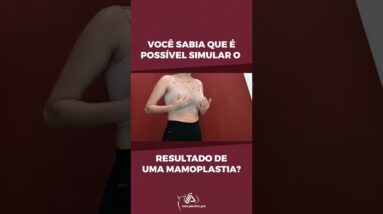 Você Sabia que é Possível Simular o Resultado de uma Mamoplastia?