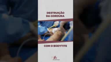 Destruição da Gordura com o Bodytite