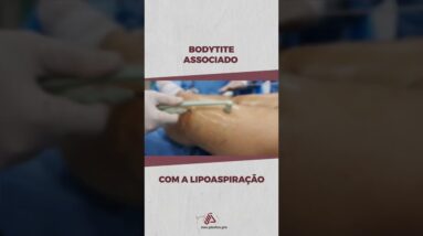 Bodytite Associado com a Lipoaspiração